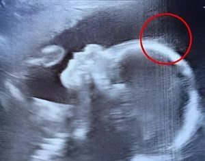 Doctors couldn’t believe what they saw during the ultrasound