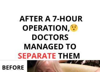 Conjoined twins separated after 7-hour surgery – This is them today