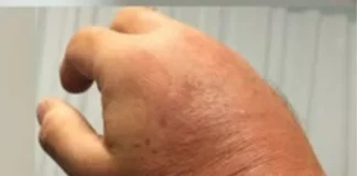 Foods that can ease swelling in hands and feet