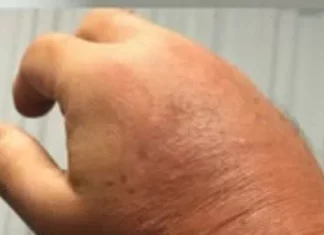 Foods that can ease swelling in hands and feet