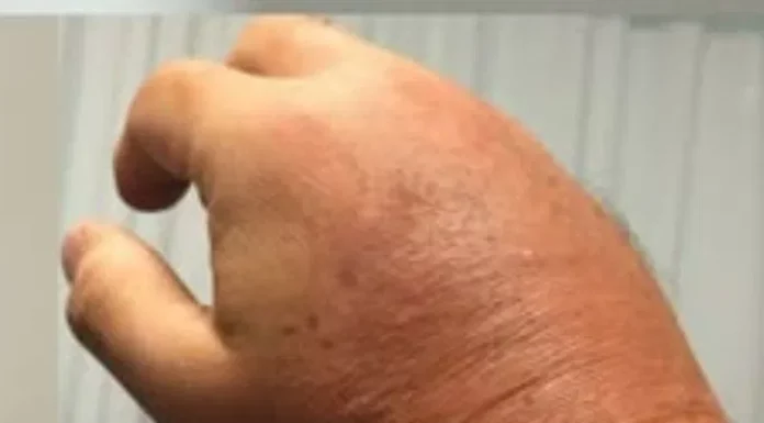 Foods that can ease swelling in hands and feet