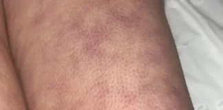 What those strange skin patterns might really mean