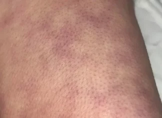 What those strange skin patterns might really mean