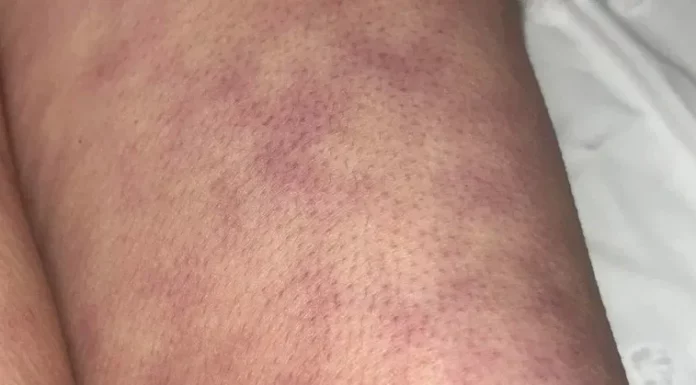 What those strange skin patterns might really mean