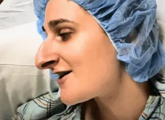 Woman spends over a decade saving for a nose job—better sit down before seeing her after