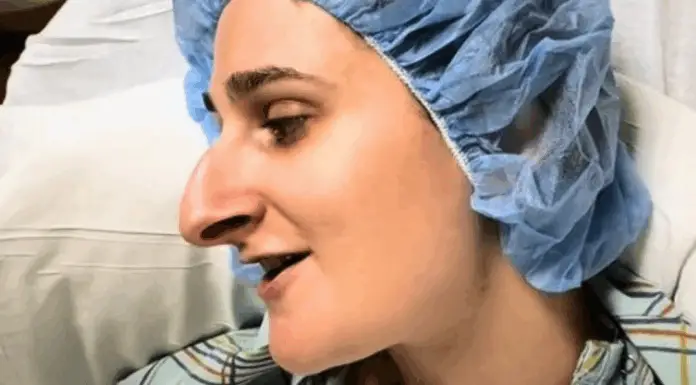 Woman spends over a decade saving for a nose job—better sit down before seeing her after