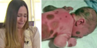 Mom doesn’t dare go outside with baby born with black spots