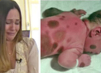 Mom doesn’t dare go outside with baby born with black spots