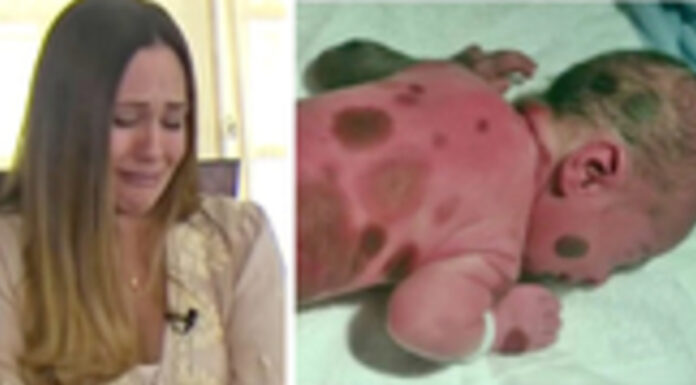 Mom doesn’t dare go outside with baby born with black spots
