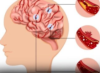 Anyone who wants to prevent a stroke needs to start eating these 15 foods immediately