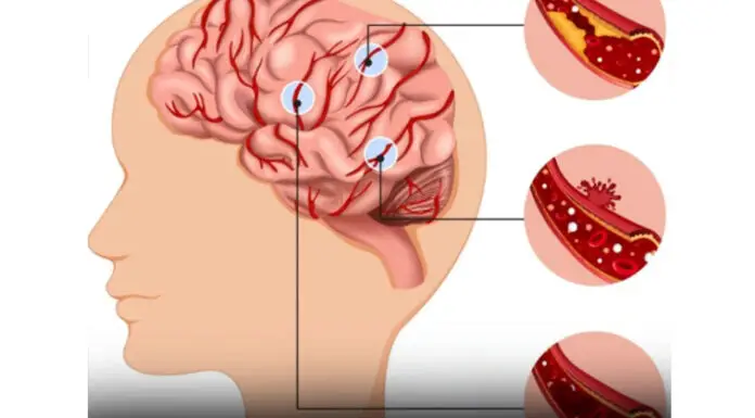 Anyone who wants to prevent a stroke needs to start eating these 15 foods immediately