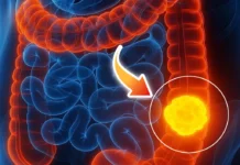 Woman reveals 5 colon cancer symptoms that shouldn’t be ignored