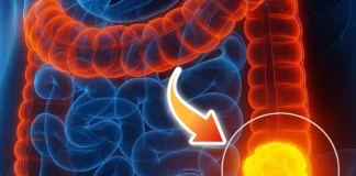 Woman reveals 5 colon cancer symptoms that shouldn’t be ignored