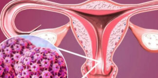 5 early warning signs of cervical cancer