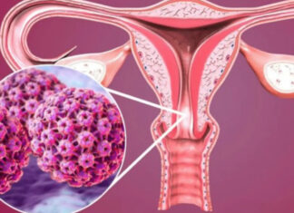 5 early warning signs of cervical cancer