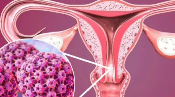 5 early warning signs of cervical cancer