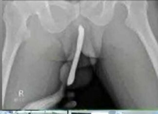 Teen Rushed to Hospital After Dangerous Experiment: A Stark Reminder on Safety