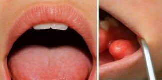 Hidden Dangers in Your Mouth: Early Signs of Oral Cancer