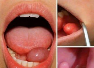 Hidden Dangers in Your Mouth: Early Signs of Oral Cancer