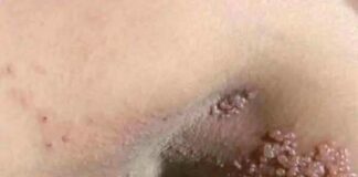 Genital Skin Changes: When to Worry and When to Relax