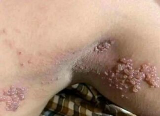 Genital Skin Changes: When to Worry and When to Relax