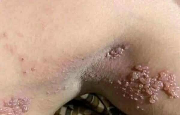 Genital Skin Changes: When to Worry and When to Relax