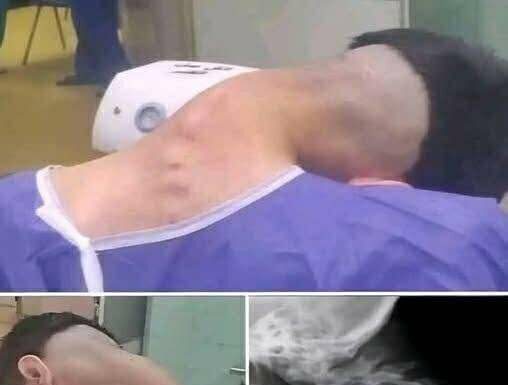 Neck Collapse Alert: Young Man Hospitalized with Dropped Head Syndrome