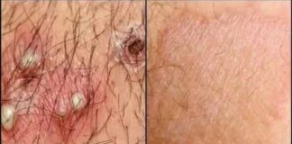 Herpes Zoster Uncovered: Causes, Warning Signs, and the Best Ways to Fight Back