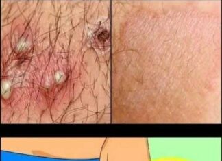 Herpes Zoster Uncovered: Causes, Warning Signs, and the Best Ways to Fight Back