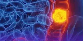 Woman reveals 5 colon cancer symptoms that shouldn’t be ignored