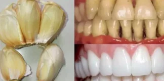 Improve your oral health naturally with garlic