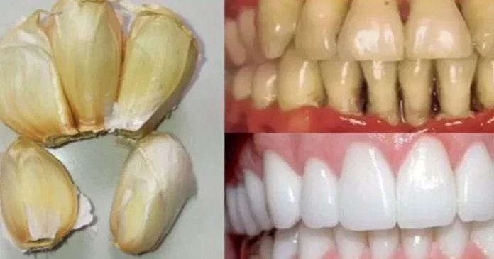 Improve your oral health naturally with garlic