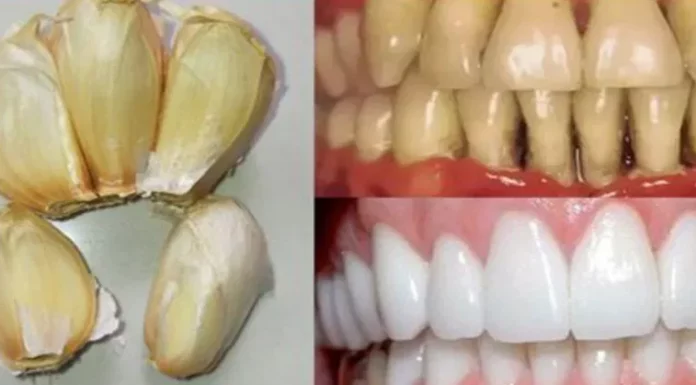 Improve your oral health naturally with garlic