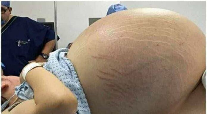 Tears of Joy Turn to Shock: A Pregnant Woman Expecting Triplets Leaves Doctors Stunned by Terrifying Discovery During C-Section