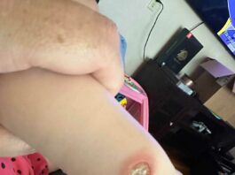 Unseen Danger: How a Common Inhaler Uncovered a Case of Sweet’s Syndrome