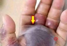 Blackened Hand Highlights the Hidden Dangers of Untreated Infections