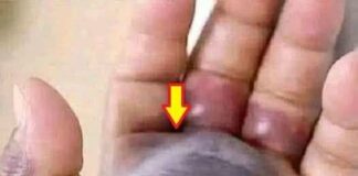 Blackened Hand Highlights the Hidden Dangers of Untreated Infections