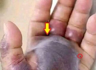 Blackened Hand Highlights the Hidden Dangers of Untreated Infections