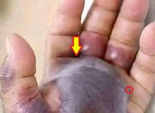 Blackened Hand Highlights the Hidden Dangers of Untreated Infections