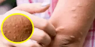 His whole body was itchy, he thought it was an allergy but then he was diagnosed