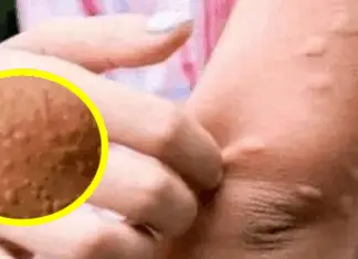 His whole body was itchy, he thought it was an allergy but then he was diagnosed