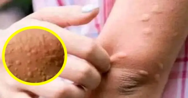 His whole body was itchy, he thought it was an allergy but then he was diagnosed