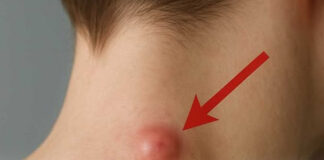 Got a lump on your neck, back or behind your ear? This is what you need to know