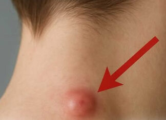 Got a lump on your neck, back or behind your ear? This is what you need to know