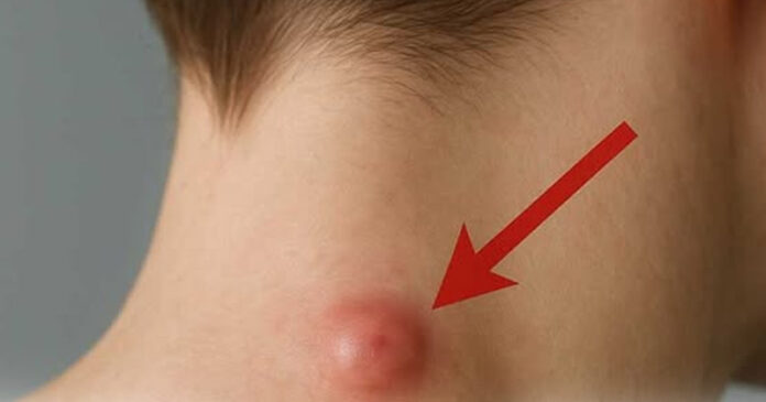 Got a lump on your neck, back or behind your ear? This is what you need to know