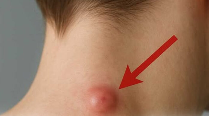 Got a lump on your neck, back or behind your ear? This is what you need to know