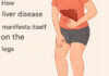 Your legs are screaming ‘HELP!:’ 5 warning signs from your liver