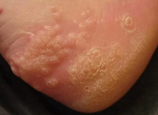 These are the consequences of wearing used…