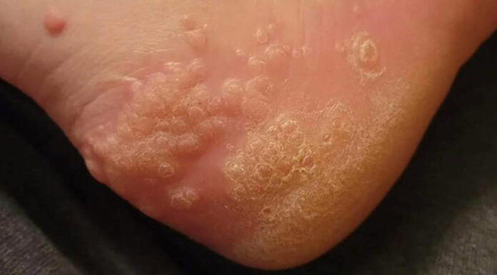 These are the consequences of wearing used…