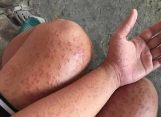 I spent a couple of nights at my friend’s previous apartment and saw these unusual bumps
